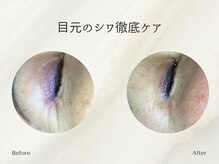 ホリスティックサロン ヘルバ(Holistic salon Herba)/目のシワケア　施術変化
