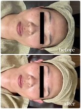 ジャスミン(Jasmin)/高濃度臍帯血幹細胞×NMN×AC-11