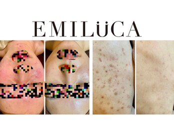 エミルカ 北谷店(EMILUCA)/ハーブピーリング専門店です♪