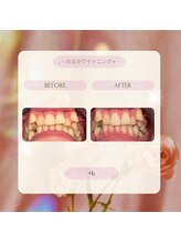 プラスビーセルフ(+b self)/ホワイトニングビフォーアフター
