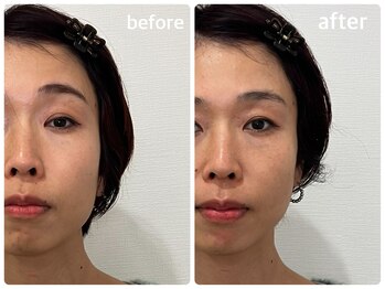 KTYフェイスジム 名古屋栄店(KTY FACE GYM)/1回のビフォーアフター♪