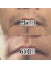 メンズ髭脱毛5回コース