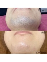 シャレールオム(Chareir Homme)/ヒゲ脱毛10回のビフォーアフター