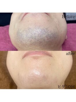 シャレールオム(Chareir Homme)/ヒゲ脱毛10回のビフォーアフター
