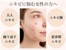 【ニキビケア／トライアル】雑菌を滅菌！プツプツ凸凹お悩み肌に◎