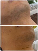 アールセカンド(R.Second)/ヒゲ脱毛!