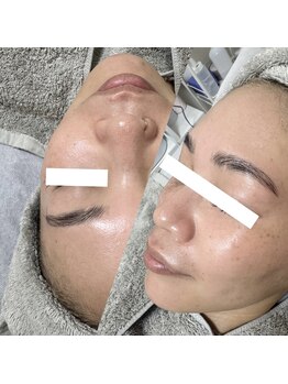 ラ フルール(La Fleur)/エアバリフェイシャルエステ