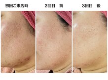 ゆらり/フェイスラインケア