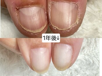 グラシナ なんば店/深爪/自爪育成/フィルイン