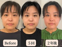 ロシュニ/40代 お悩み:たるみ/首肩こり