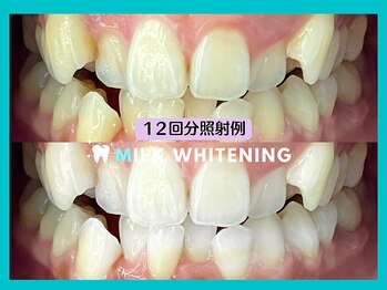 ミルクホワイトニング 新大村店(Milkホワイトニング)/★施術例