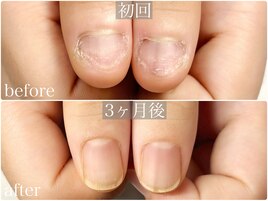 深爪解消♪自爪風長さだし
