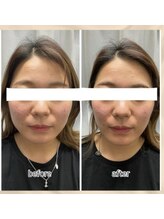 エンチャント(ENCHANT)/小顔造形×ラジオ波.EMS.EL