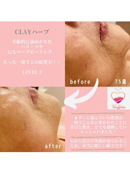 ラフェリア 弘明寺(Raffelia)/大人気♪ハーブピーリング！