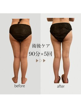 ファミーユ 名古屋店/【術後ケア】太もも吸引後ケア