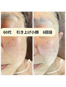 グラチア(Gratiae)/60代/引き上げ小顔コース