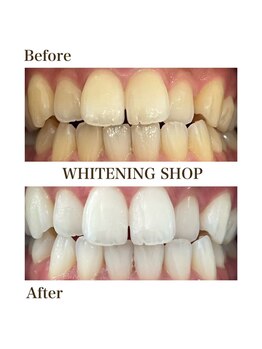 ホワイトニングショップ 岩出店(WHITENINGSHOP)/フリーパスBefore/After