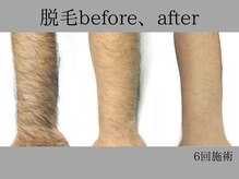 リル シャイン(Rill SHINE)/メンズ脱毛6回施術！