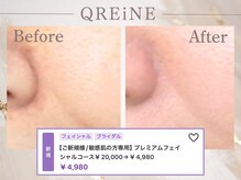 クレーヌ(QREiNE)/敏感肌の方へのフェイシャル