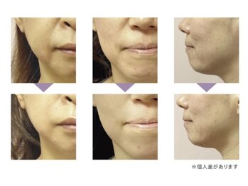 トータルエステティック レイ(Lay)/たるみ、しわ改善！リフトアップ