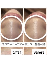 サロンドビジュー(salon de bijou)/ハーブピーリング×毛穴sp