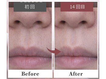 フルリール/【全顔脱毛】