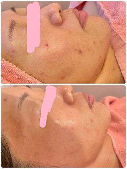 ヒメミ(Himemi)/BBL光フェイシャル