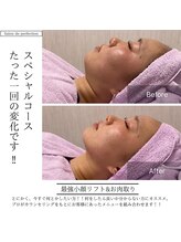 サロン ド パーフェクション(Salon de Perfection)/小顔リフト