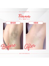 ティアナ 盛岡大通店(Tiana)/ ワキ脱毛 Before&After