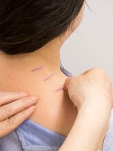 きよみ治療院/即効性のある鍼