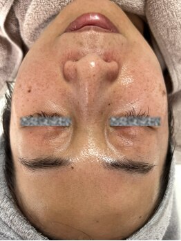 リアスキン(Lia skin)/シミ、毛穴でお悩みの方