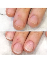 リファーレ(RIFARE)/【深爪矯正】長さ出し＋深爪矯正