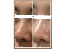 リノズ(Lino's)の雰囲気（頑固な黒ずみ！！いちご鼻◎）