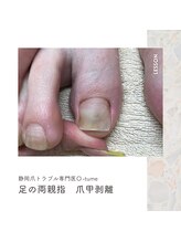 オツメ 静岡(O-tume)/剥離の為人口爪を