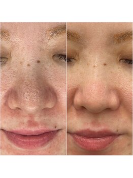 グランデ(Grande)/プラズマニア毛穴引き締め効果◎