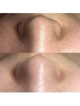 ビューティーネイル(Beauty Nail)/毛穴エクストラクション