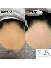 F&B/うなじのワックス脱毛