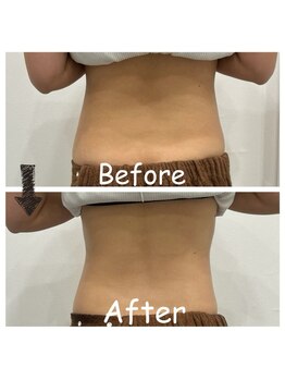 ナニワ ビューティー(naniwa beauty)/WINBACKお腹集中