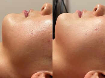 ゾーンビューティーハウス 柏店(ZONE BEAUTY HOUSE)/☆REVI陶肌トリートメント☆