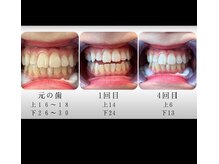 エクシアホワイトニング 新白河店/ホワイトニングビフォーアフター