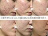 ニキビ悩みを解決する初回体験コース【ニキビ/根本改善】