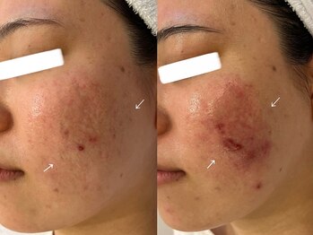 ナポデイズ(NAPODAYS)/肌質改善ピール/経過途中