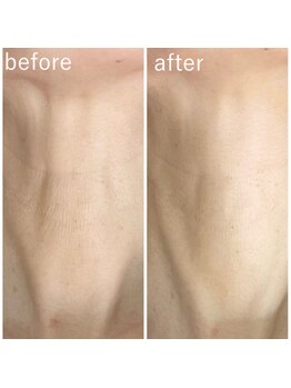 フジモトサロン 那覇おもろまち店(fujimotoサロン)/首元のシワで悩んでいる方必見