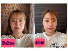 ノウ(nou)/20代　女性　施術1回の効果！