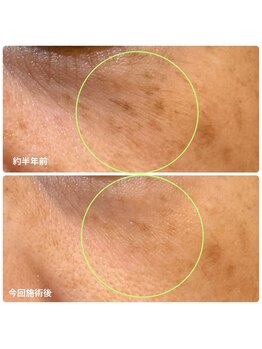 チョチョワンプラス(緒々one+)/薄いシミやくすみにおすすめ