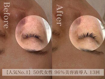 ディレイア ザ コスメ 有楽町マルイ店(direia the cosme)/月1~2/シミ/くすみ/しわ[有楽町]