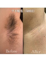 ミノア 熊本店(MINOA)/メンズ◆脇脱毛