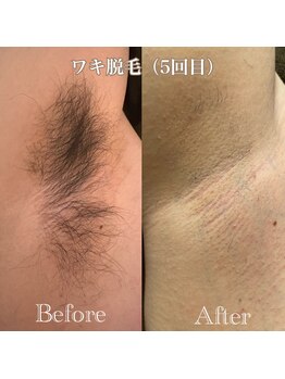 ミノア 熊本店(MINOA)/メンズ◆脇脱毛