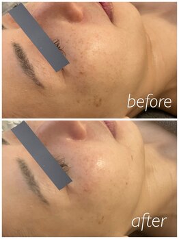 シス(SiS)/ハーブピーリング