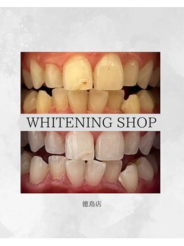 ホワイトニングショップ 徳島店/Before&After美白ホワイトニング